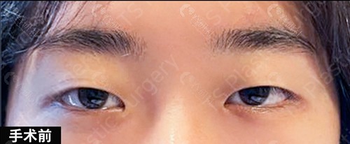韩国TS医院自然粘连双眼皮+眼肌矫正术前