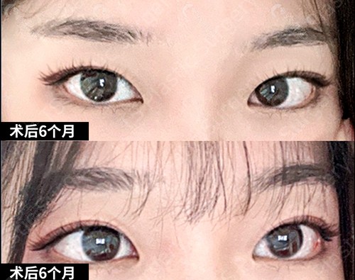 韩国TS自然粘连双眼皮+眼肌矫正术后6个月