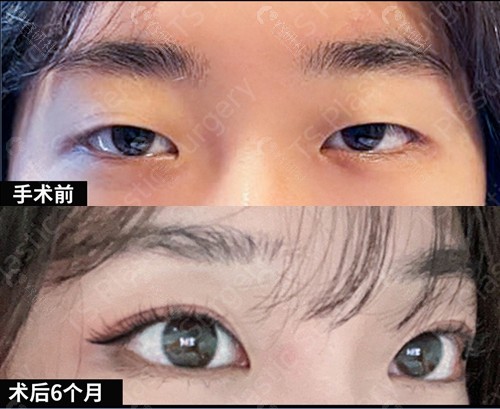韩国TS自然粘连双眼皮+眼肌矫正术前和术后6个月对比图