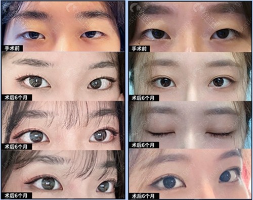 韩国TS整形外科李相均自然粘连法双眼皮效果对比图