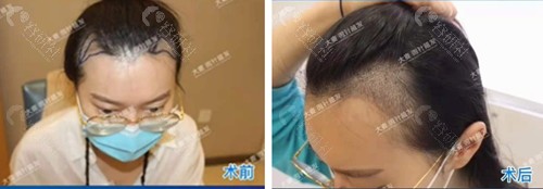 郑州大麦微针植发对比照片