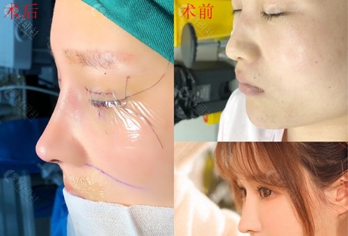 贵州利美康整形外科医院骆显红医生隆鼻前后对比图