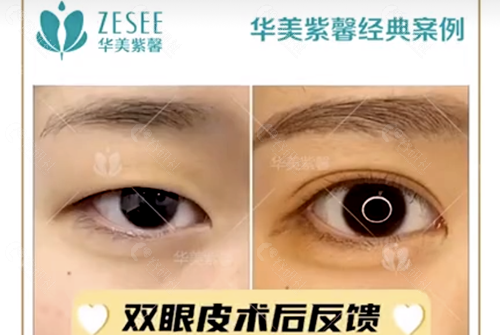 贵州贵阳华美紫馨整形美容医院双眼皮术前术后效果对比图