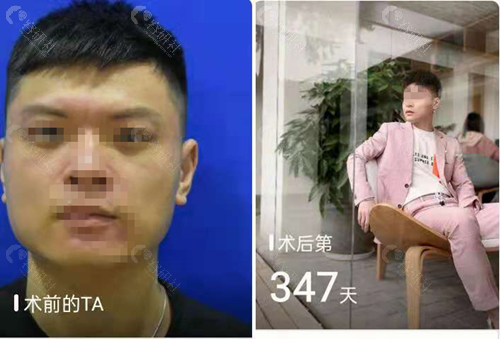 武汉亚韩整形外科医院下颌角磨骨对比照