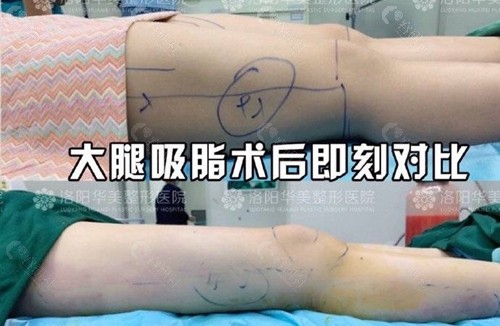 洛阳华美医疗美容整形大腿吸住术前术后对比图