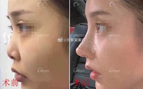 洛阳孔繁荣医疗美容门诊部隆鼻术前术后对比图