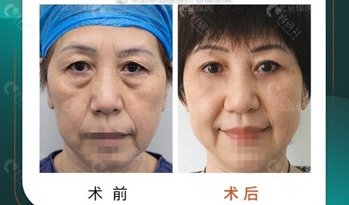 北京煤医医疗美容医院提眉手术术前术后对比效果图展示