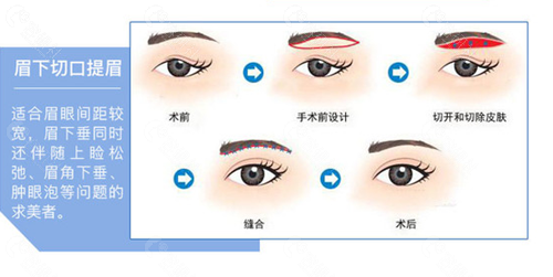 北京百达丽医疗美容门诊部做切眉手术的原理示意图