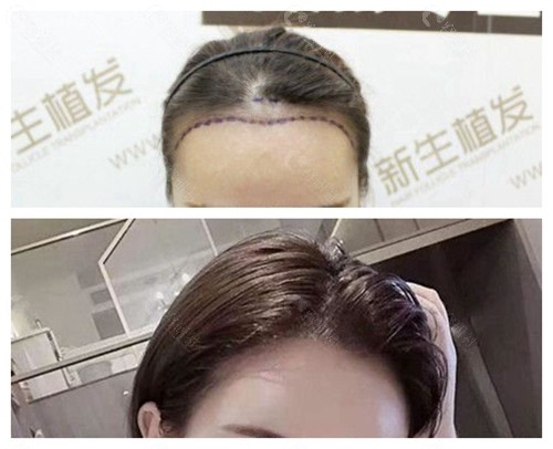 北京新生植发前后对比照片