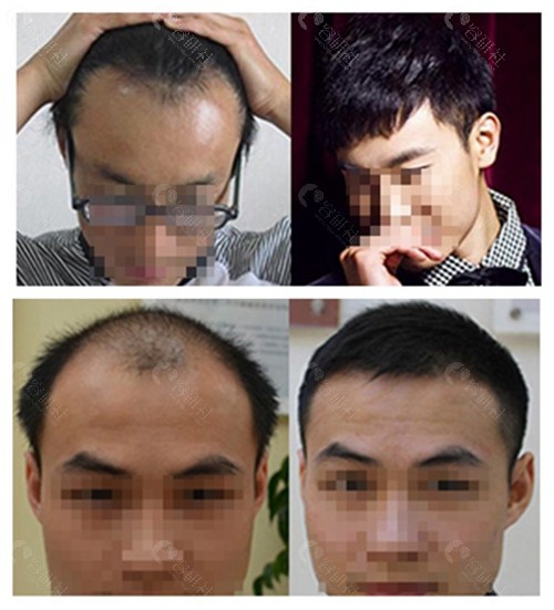 北京大麦微针植发前后对比效果图