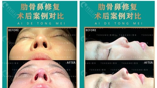 北京彤美李长赋做的肋软骨隆鼻修复术前术后对比效果图