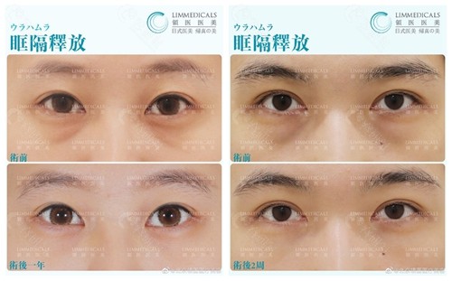 北京领医医疗美容眶隔释放去眼袋术前术后对比效果图