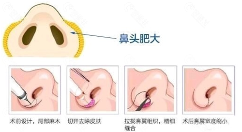 鼻头缩小手术方法