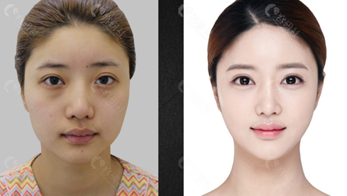韩国必当归做双眼皮修复术前