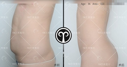 北京艺美医疗美容腰腹威塑吸脂术前术后对比效果图