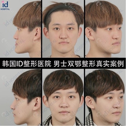 韩国ID医院男士双鄂整形前后对比图