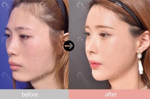 韩国VG百利酷整形医院面部轮廓手术前后对比图