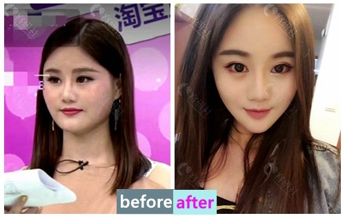 韩国绮林整形外科李承龙面部轮廓手术前后对比图
