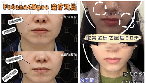 北京画美医疗美容医院欧洲之星Fotona4D面部治疗前后对比效果图