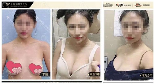 北京润美玉之光王明利医生自体脂肪丰胸术前术后对比效果图