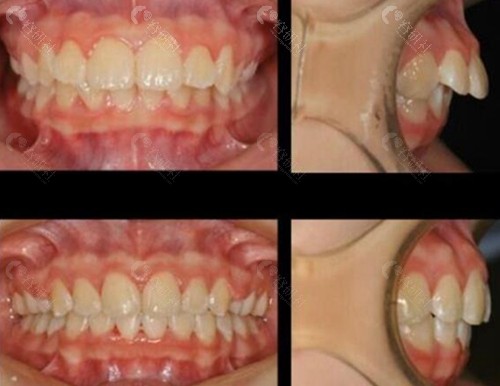 上海鼎植口腔牙齿矫正前后对比照
