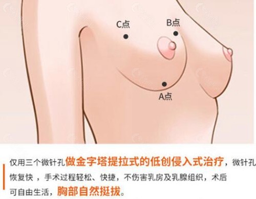 深圳曹孟君胸部下垂矫正优势介绍