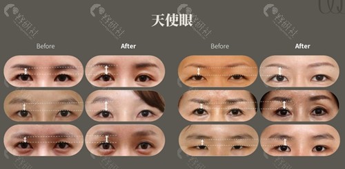 韩国原辰整形外科天使眼双眼皮展示