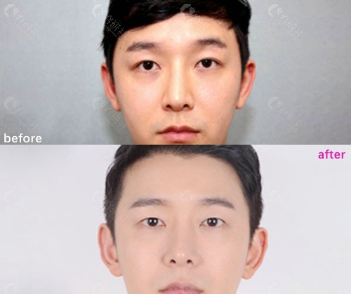 韩国SoonPlus纯嘉整形外科男士双改单前后对比图