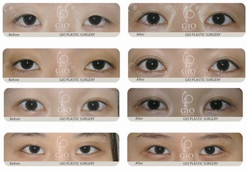 韩国gio整形外科医院双眼皮不对称修复前后对比图