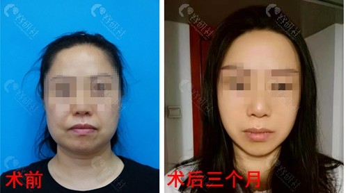找北京加减美穆宝安v美面部提升术前和术后3个月前后对比效果图