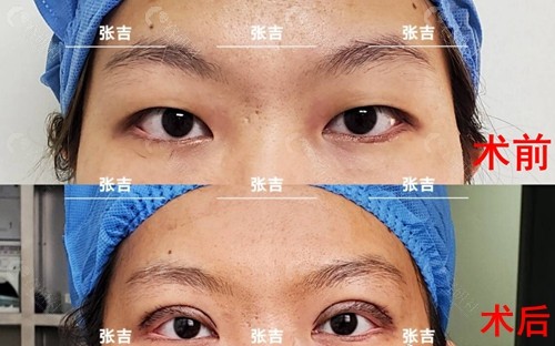 广州南方医科大学珠江医院张吉医生全切双眼皮对比图