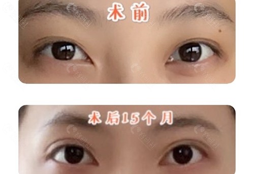 广东省第二人民医院汪海滨医生埋线双眼皮修复