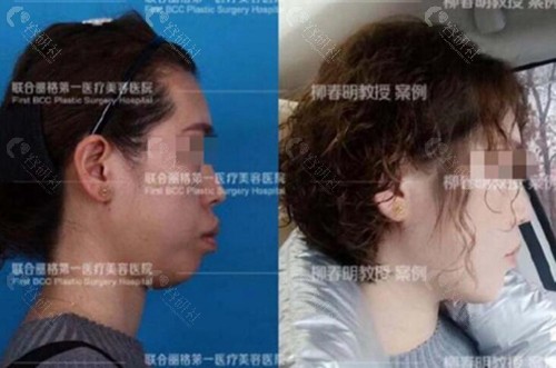 北京联合丽格柳春明正颌手术前后对比照