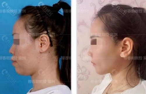 北京联合丽格柳春明正颌术前术后对比