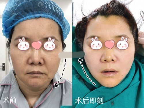 上海玺美医疗美容吕京陵面部提升术后对比照