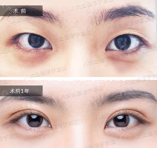北京八大处于晓波修复双眼皮前后对比照片