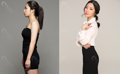 在韩国必当归做腰腹环吸前后对比照片
