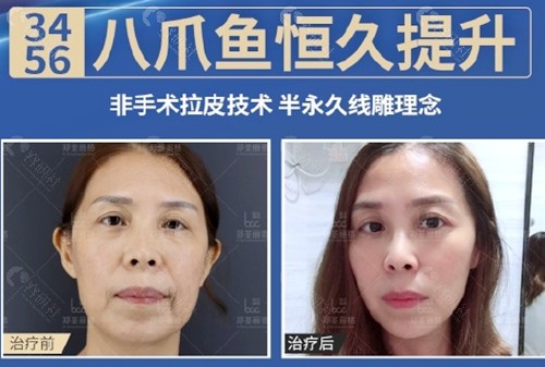 重庆郑荃丽格刘涛院长八爪鱼面部提升术治疗前后效果图