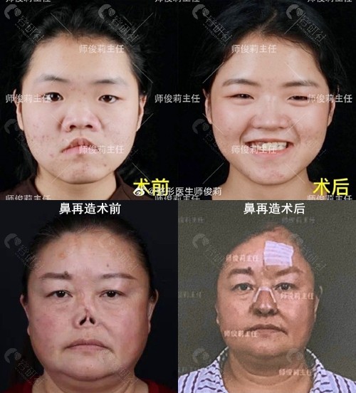 隆鼻医生师俊莉外伤性鼻缺损再造术前术后图片
