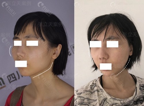 下颌角手术前后图片