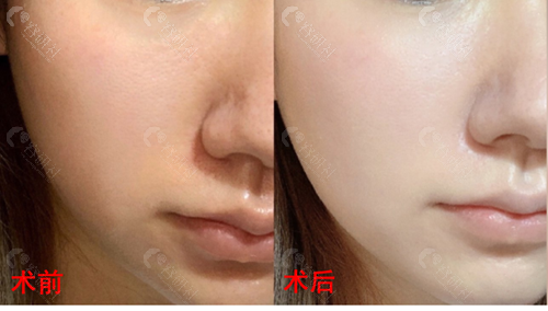 北京薇琳医疗美容医院光子嫩肤术前术后对比图