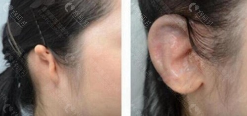 韩国普罗菲耳整形外科郑在皓小耳畸形矫正前后对比照片