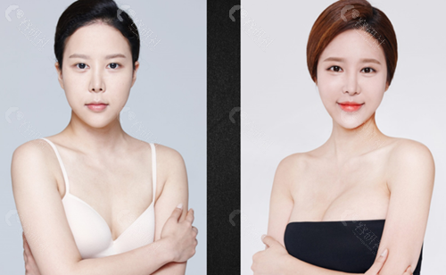 韩国必当归假体隆胸术前术后对比照片