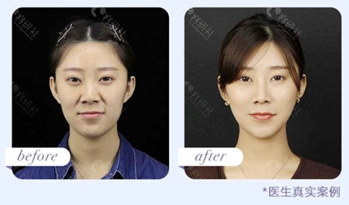 北京首玺丽格医疗美容医院韩胜面部综合抗衰前后对比图