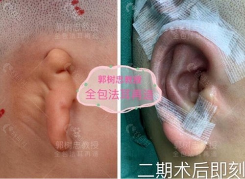 西安国医整形郭树忠小耳畸形矫正前后对比照