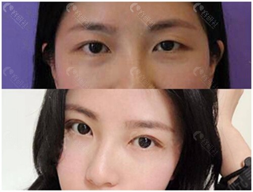 遵义韩美医疗美容割双眼皮术后照片