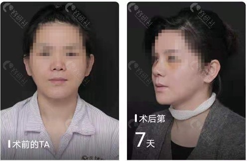 北京沃尔鼻修复对比照