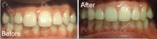 牙齿矫正前后对比照片