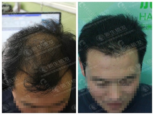 新生3D植发头顶加密种植对比照片