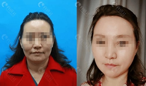 北京加减美穆宝安小切口拉皮手术对比照